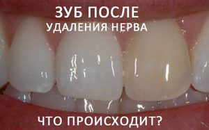 Болит зуб после удаления нерва