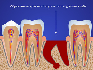 Почему болит зуб после удаления нерва