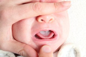 Язвочки во рту у малыша