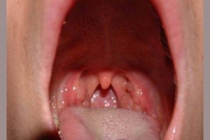 Методы лечения больного горла