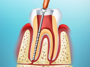 Процедура удаления зубного нерва