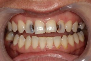 Возможные причины зубной боли