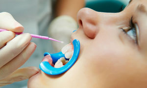 Что такое фторирование зубов