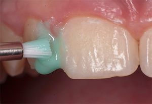 Как проходит покрытие зубов фторлаком