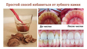 Методы избавления от зубного камня
