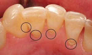 Средства в борьбе с зубными камнями