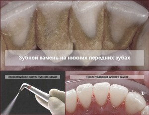 Метод избавления от зубного камня