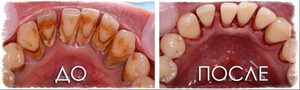 Способы борьбы с зубными камнями