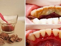 Как можно удалить зубной камень