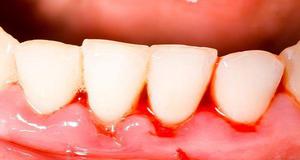 Как можно укрепить шатающийся зуб