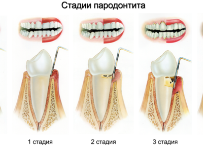 Укрепление десен и шатающихся зубов народными средствами