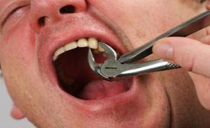Показания к удалению коренного зуба