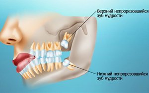 Как удаляют зубы