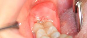 Альвеолит  после удаления зуба