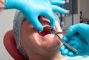 Метод удаления корней, когда зуб полностью разрушен
