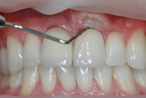 Описание консервативного метода сохранения корней зубов