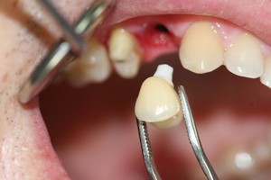 Методы и нюансы удаления корней зуба