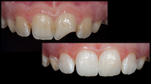 Основные методы реставрации зубов