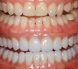 Описание процесса художественной реставрации зубов