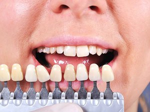 Описание нюансов восстановления эстетичного вида зубов