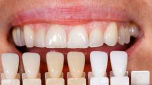 Описание альтернативных вариантов реставрации зубов