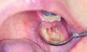 Осложнения после удаления зуба при неправильном уходе