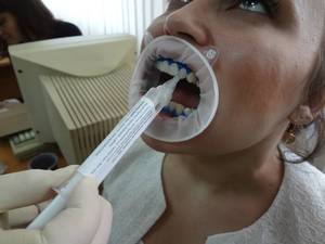 Отбеливание зубов amazing white