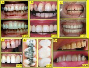 Особенности зубных виниров