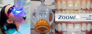 Отбеливание зубов-Zoom