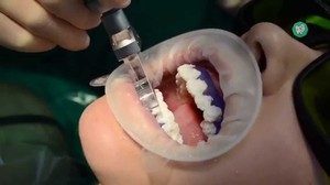   Виды отбеливания зубов