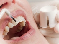 Особенности восстановления зубной эмали