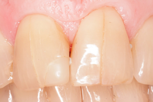 Показания для восстановления зубной эмали