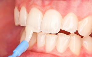 Описание метода реминерализации зубов для восстановления эмали