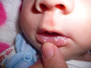 Молочница на губах у ребенка