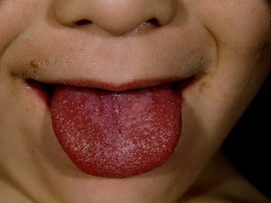 Красная сыпь на языке ребенка при скарлатине