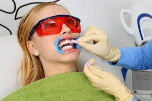 Описание метода химического отбеливания зубов