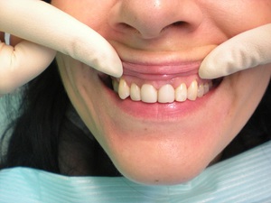 Преимущества и недостатки эндоотбеливания зубов
