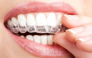 Профессиональные средства для отбеливания зубов в домашних условиях