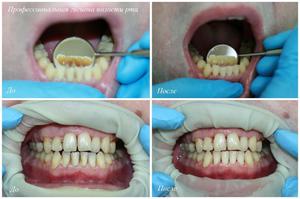 Стомотологическая чистка зубов