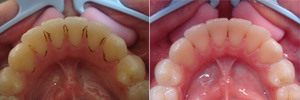 По каким причинам возникает зубной налет