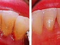 Способы избавления от зубного налета