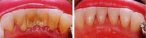 Способы избавления от зубного налета