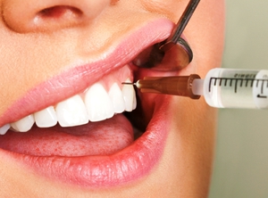 Способы вырывания зубов