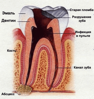 Сколько можно держать мышьяк в зубе для получения результата без вреда