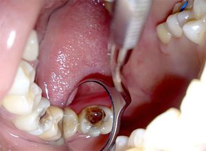 Удаление зубного нерва - разные методы
