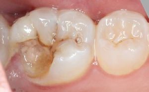 Зачем нужен мышьяк в зубе и когда от него избавляться
