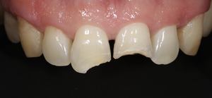 Скол зуба с повреждением дентина