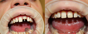 Использование штифтов в стоматологии