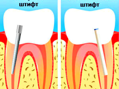 Что такое зубной штифт фото