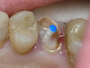 Как реставрируют зубы